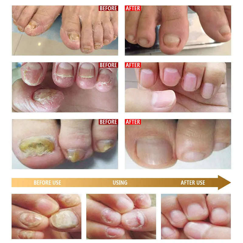 ARTISCARE Nail Care Essence Feet Care Nail Serum 20mL