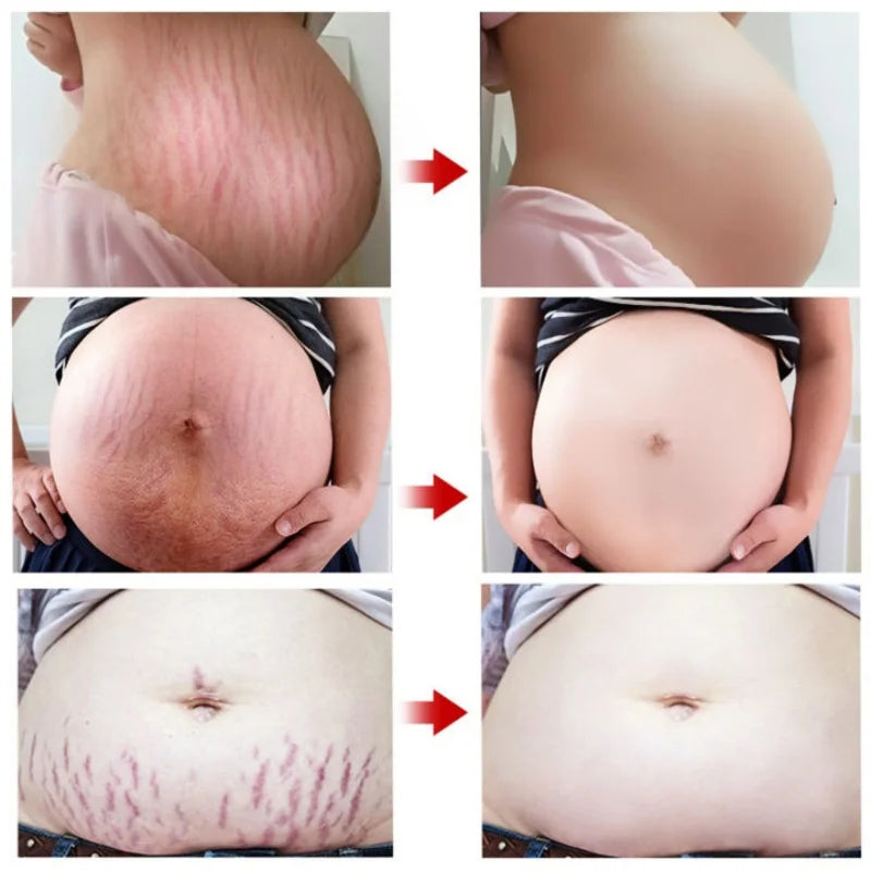 Stretch Marks Permanent Removal Cream Maternity Pregnant Women Pregnancy Anti-Winkle Smooth Repair Firming Skin Body Skin Care