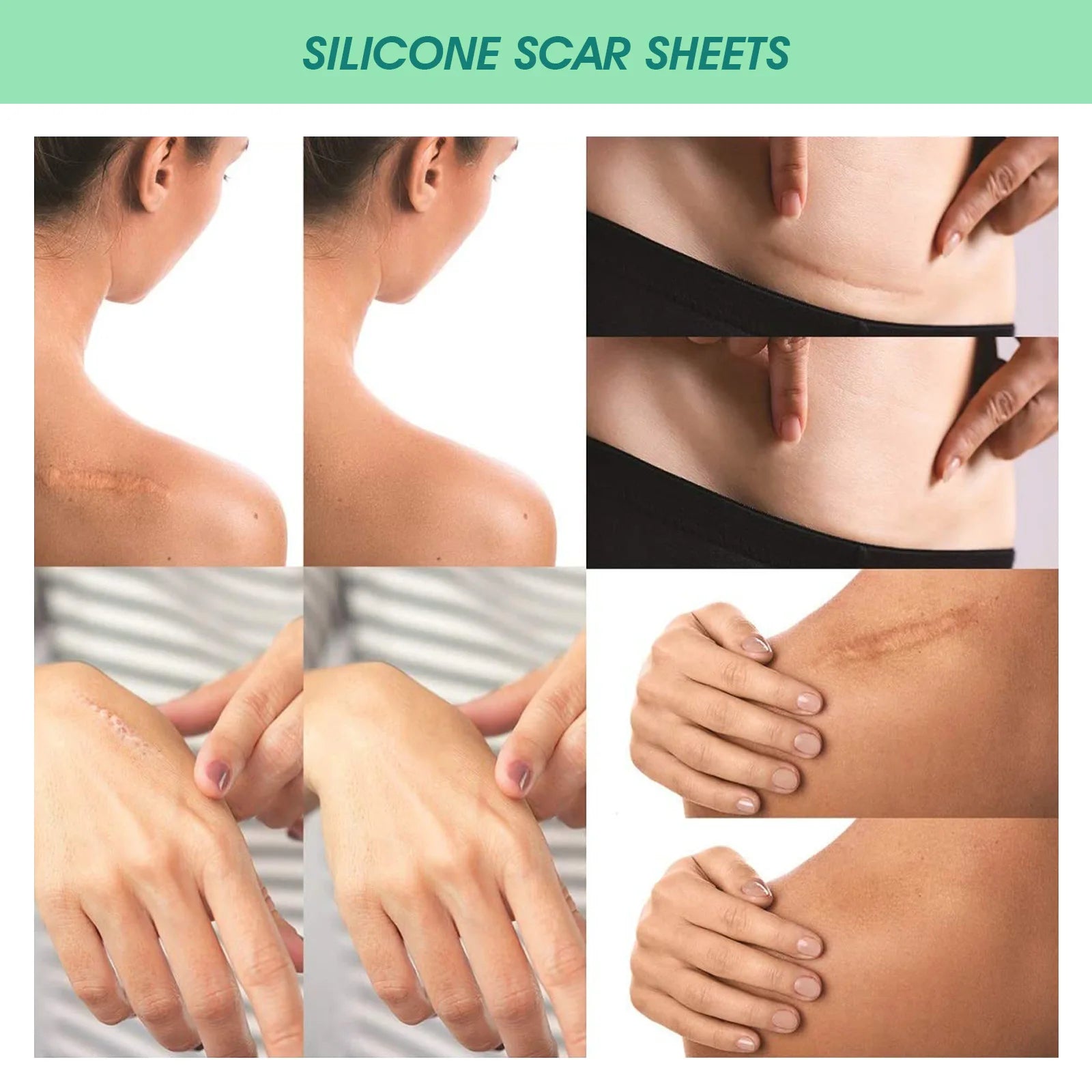 Scar Patches Remove Silicone Gel Sheet Correctors Burn Wounds Efficient Surgery Scar Tape Skin Repair Self-Adhesive Scar Cover