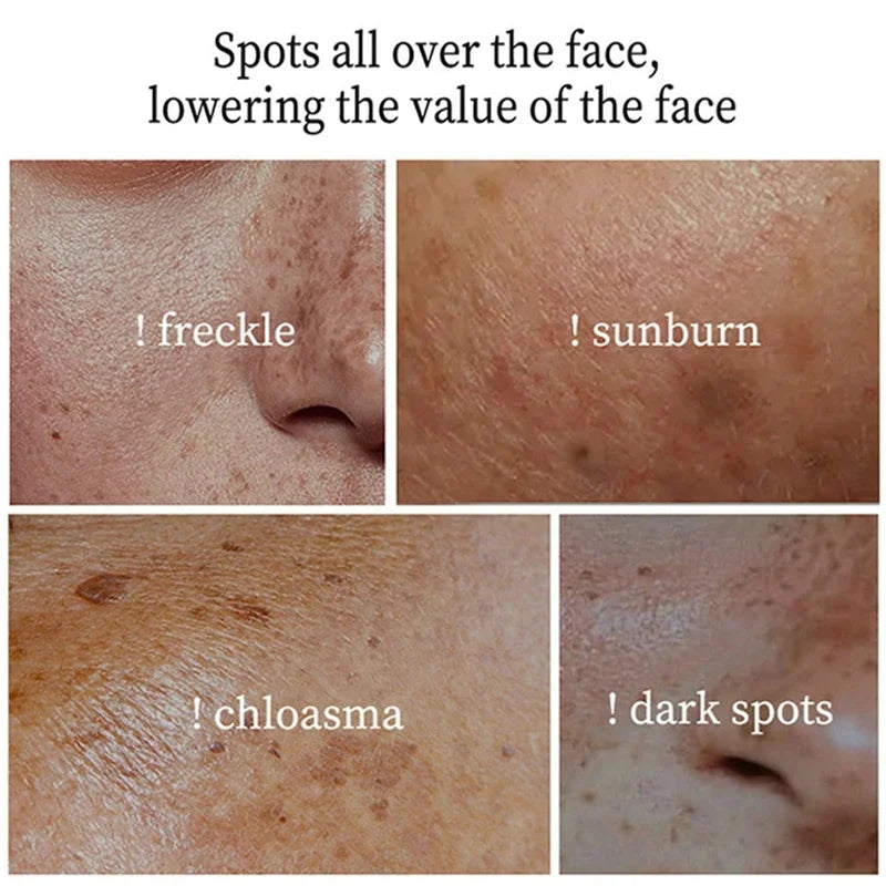 Powerful Spot-Removing Whiten Cream Brighten Skin Fast Eliminates Melanin Pigmentation Melasma Dark Spots Korean Face Skin Care