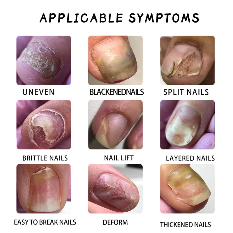 Fungal Nail Treatment Serum 7 Days Fungus Removal Treating Paronychia Liquid Anti Gray Nails Infection Foot Repair Care Tools