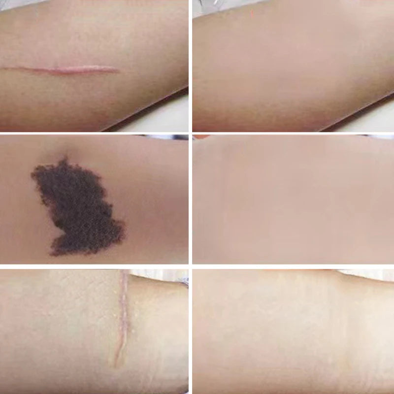 6 Pcs Tattoo Scar Flaw Concealing Tapes Waterproof Tattoo Film Ultra Thin Patch Tattoo Scar Patches Birthmark Concealing Sticker