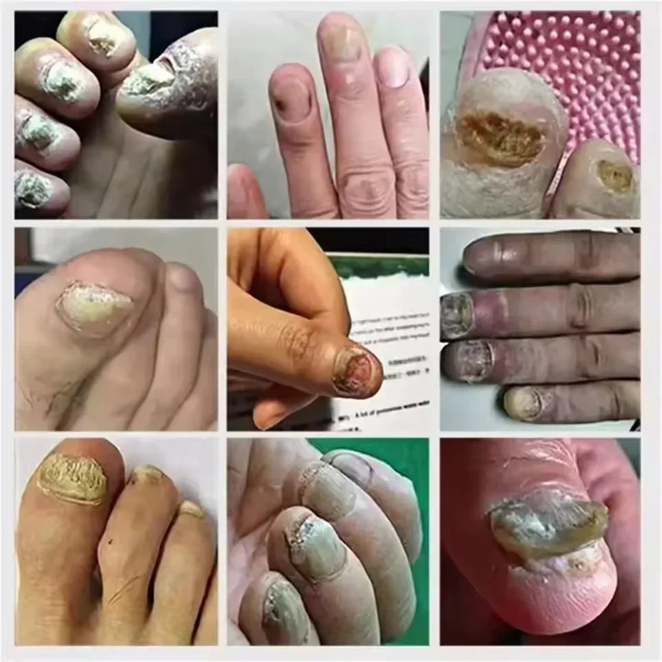 7 DAYS Nail Fungus Treatments Liquid Serum Anti-Infection Onychomycosis Paronychia Hand Care Nails Foot Fungal Removal Gel 10ml