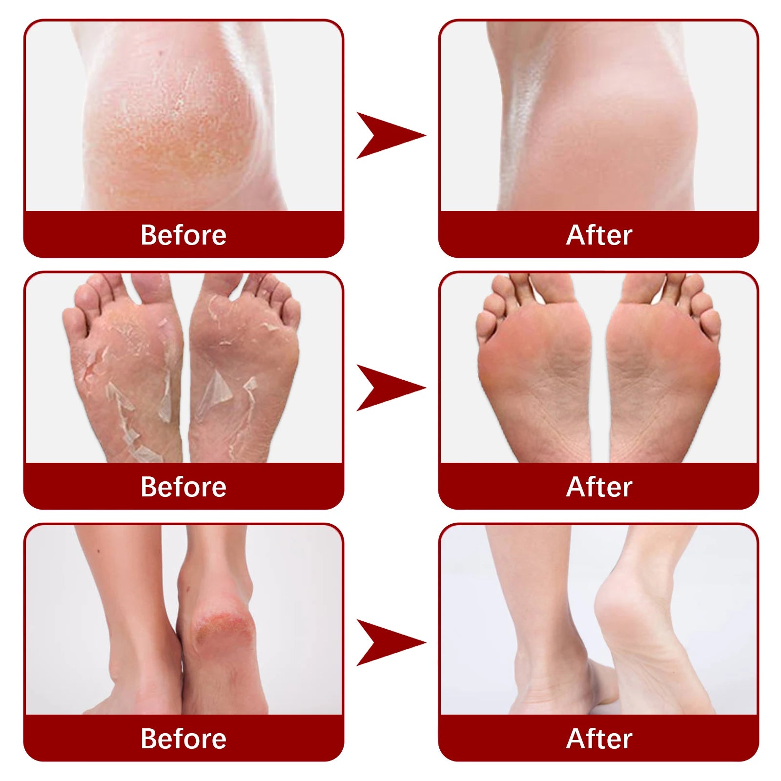 5pairs Foot Mask Fruit Acid Exfoliating Dead Skin Remove Anti Crack Foot SPA Peeling Pedicure Socks Scrub Moisturizer Care Patch