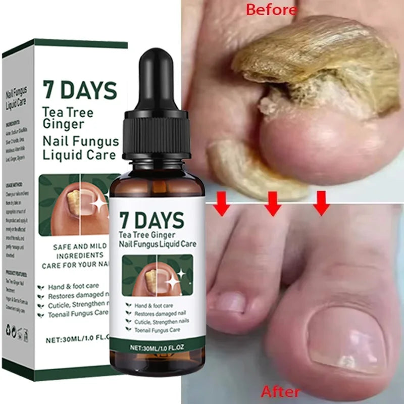 Fungal Nail Treatment Serum 7 Days Fungus Removal Treating Paronychia Liquid Anti Gray Nails Infection Foot Repair Care Tools