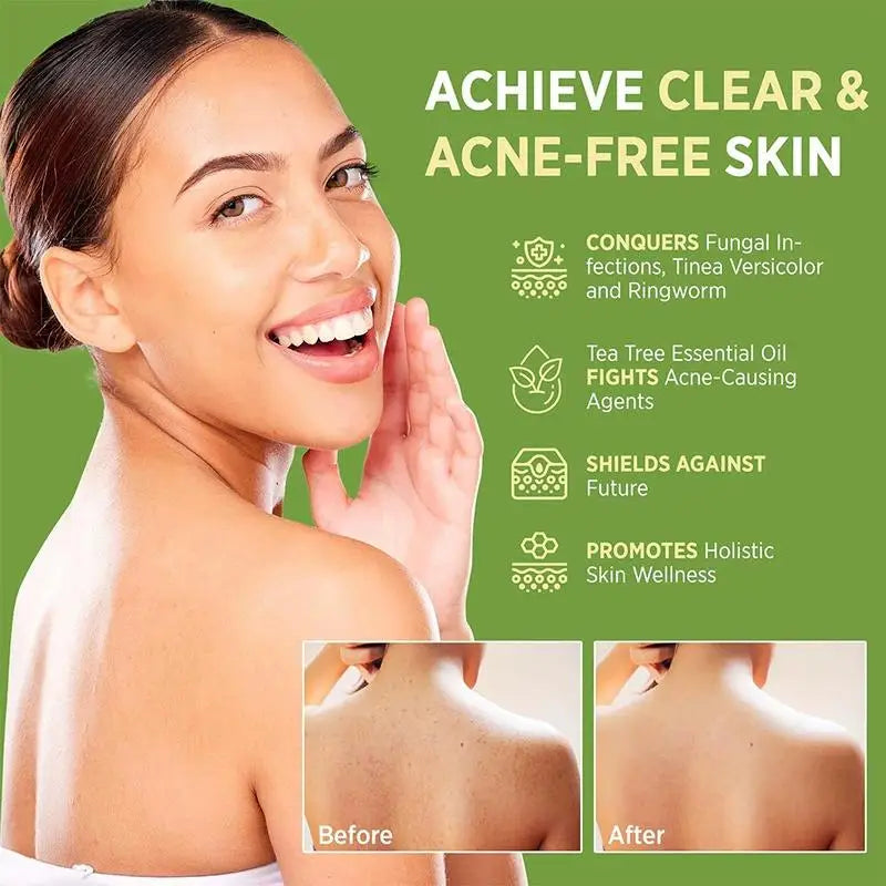 MIAOFUTONG Gentle For Sensitive Skin TEA TREE OILANTIFUNGAL SOAP Plant-Based Care Moisturizing FormulaG Lmproving Acne