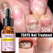 Fungal Nail Treatment Serum Foot Nail Fungus Removal Repair Gel Anti Infection Paronychia Onychomycosis Foot Nails Care Essence