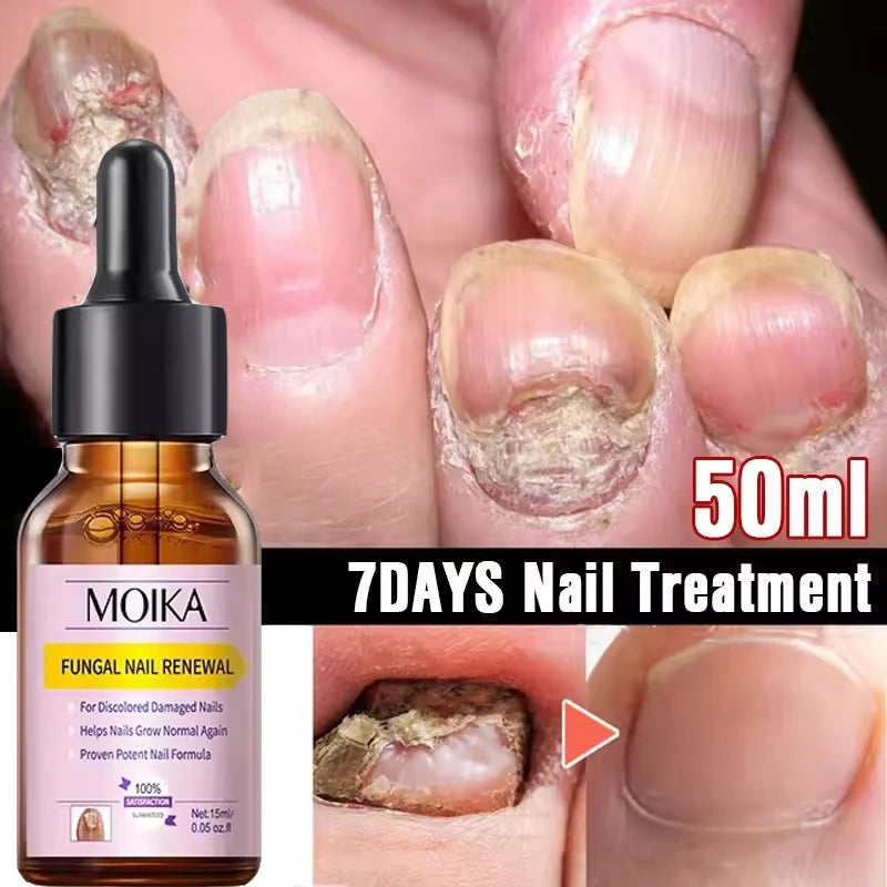 Fungal Nail Treatment Serum Foot Nail Fungus Removal Repair Gel Anti Infection Paronychia Onychomycosis Foot Nails Care Essence