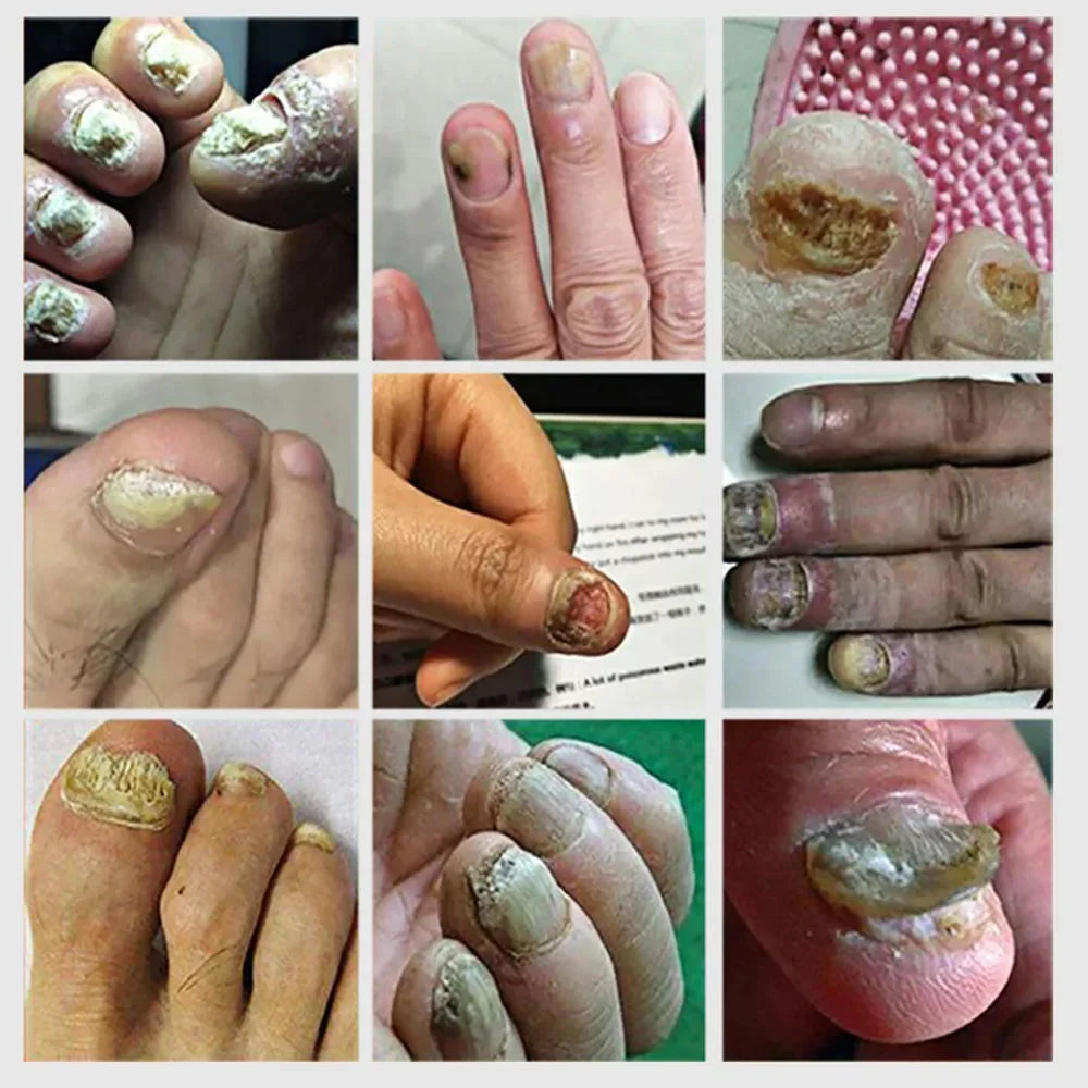 Nail Fungus Treatment Serum Foot Repair Liquid Toe Nails Fungal Removal Gel Anti Infection Paronychia Onychomycosis Cream 10ml