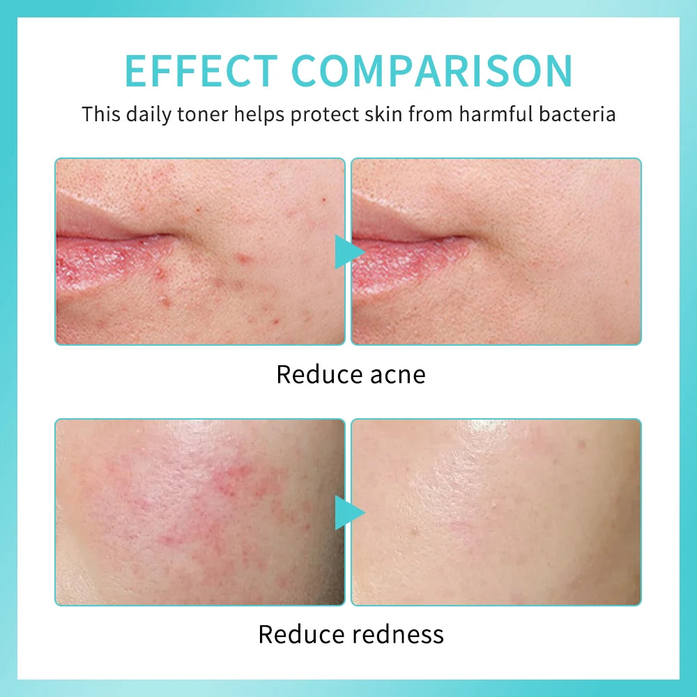Hypochlorous Acid Spray Toner for Face Helps Reduce Redness Breakouts Soothing pH Balancing Toner Skincare