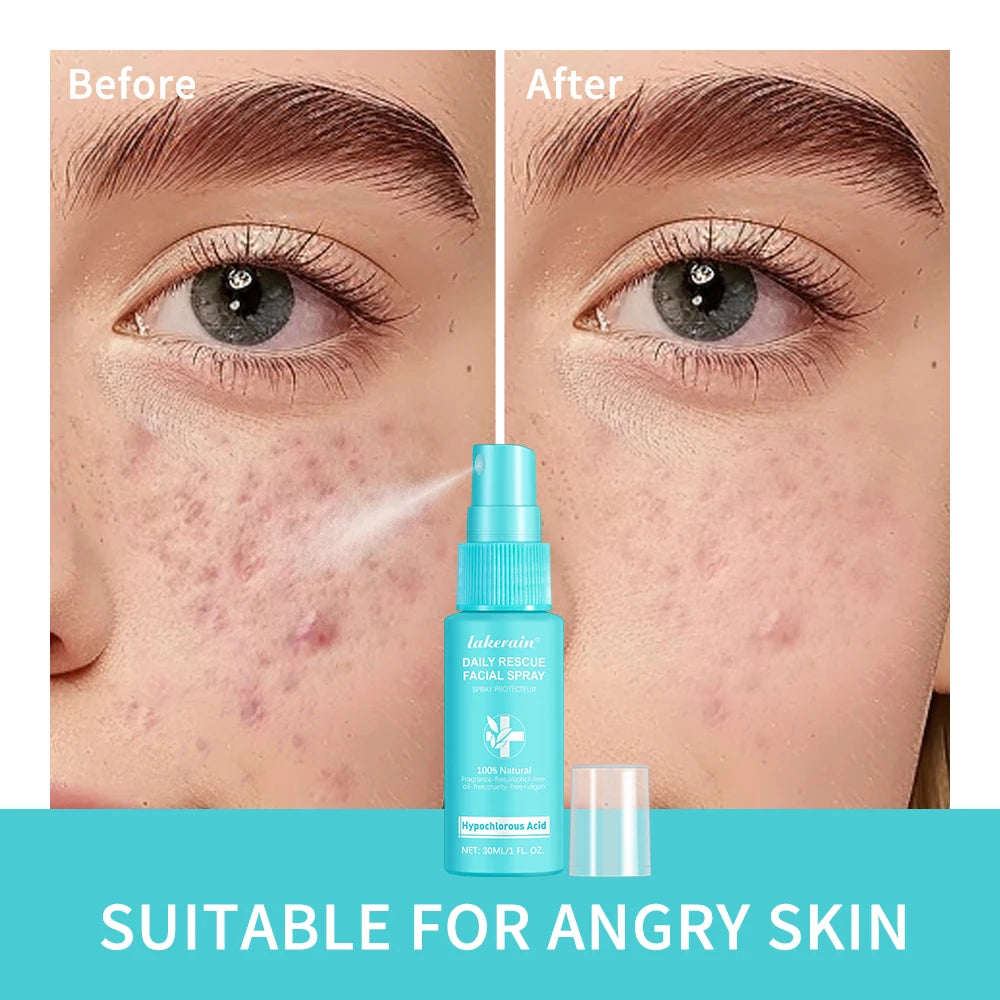 Hypochlorous Acid Spray Toner for Face Helps Reduce Redness Breakouts Soothing pH Balancing Toner Skincare