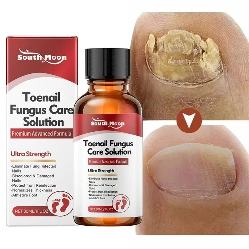 Fungal Nail Treatment Serum Nails Fungus Removal Treating Paronychia Liquid Anti Gray Nails Toe Infection Foot Repair Care Tools