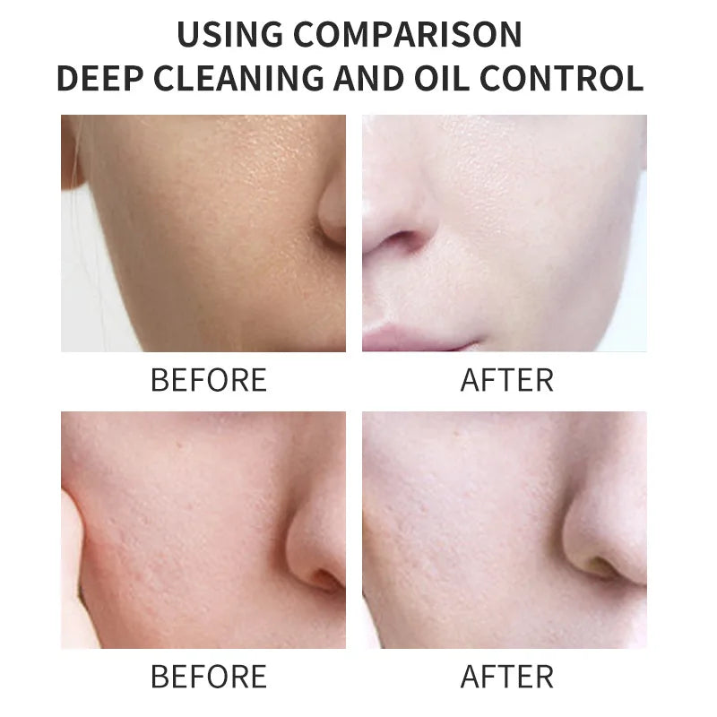 Kojic Acid Skin Care Facial Wash Mild Oil Control Deep Cleaning Moisturizing Cleansing Nonirritating Face Cleanser Face Wash