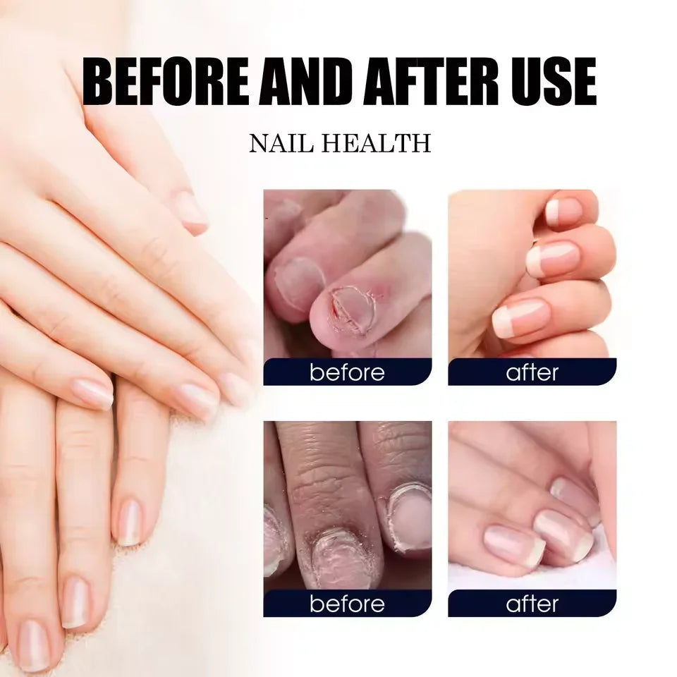 7 DAYS Nail Fungus Treatments Liquid Serum Anti-Infection Onychomycosis Paronychia Hand Care Nails Foot Fungal Removal Gel 10ml