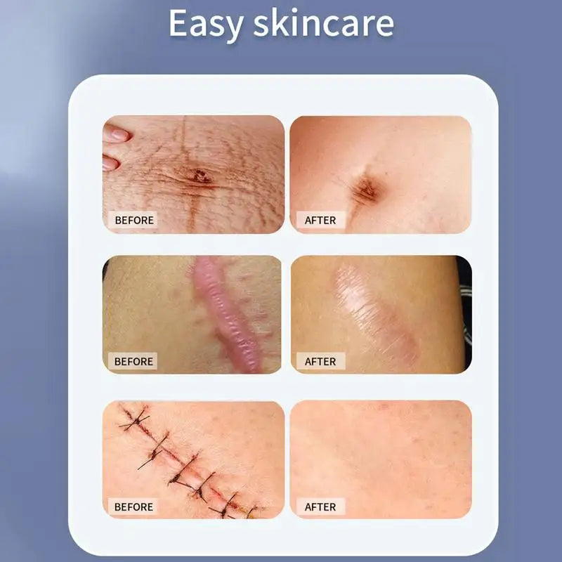 Self-Adhesive Silicone Scar Tape Scar Sheets Soft Silicone Reusable Scar Away Scar Tape Effective Skin Care Strips 4x50cm
