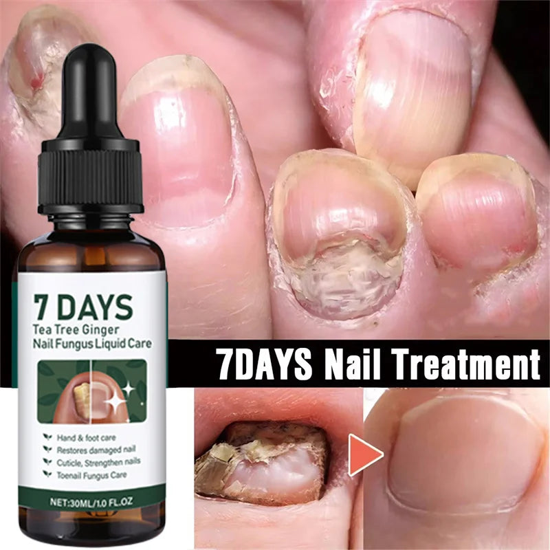 Fungal Nail Treatment Serum 7 Days Fungus Removal Treating Paronychia Liquid Anti Gray Nails Infection Foot Repair Care Tools