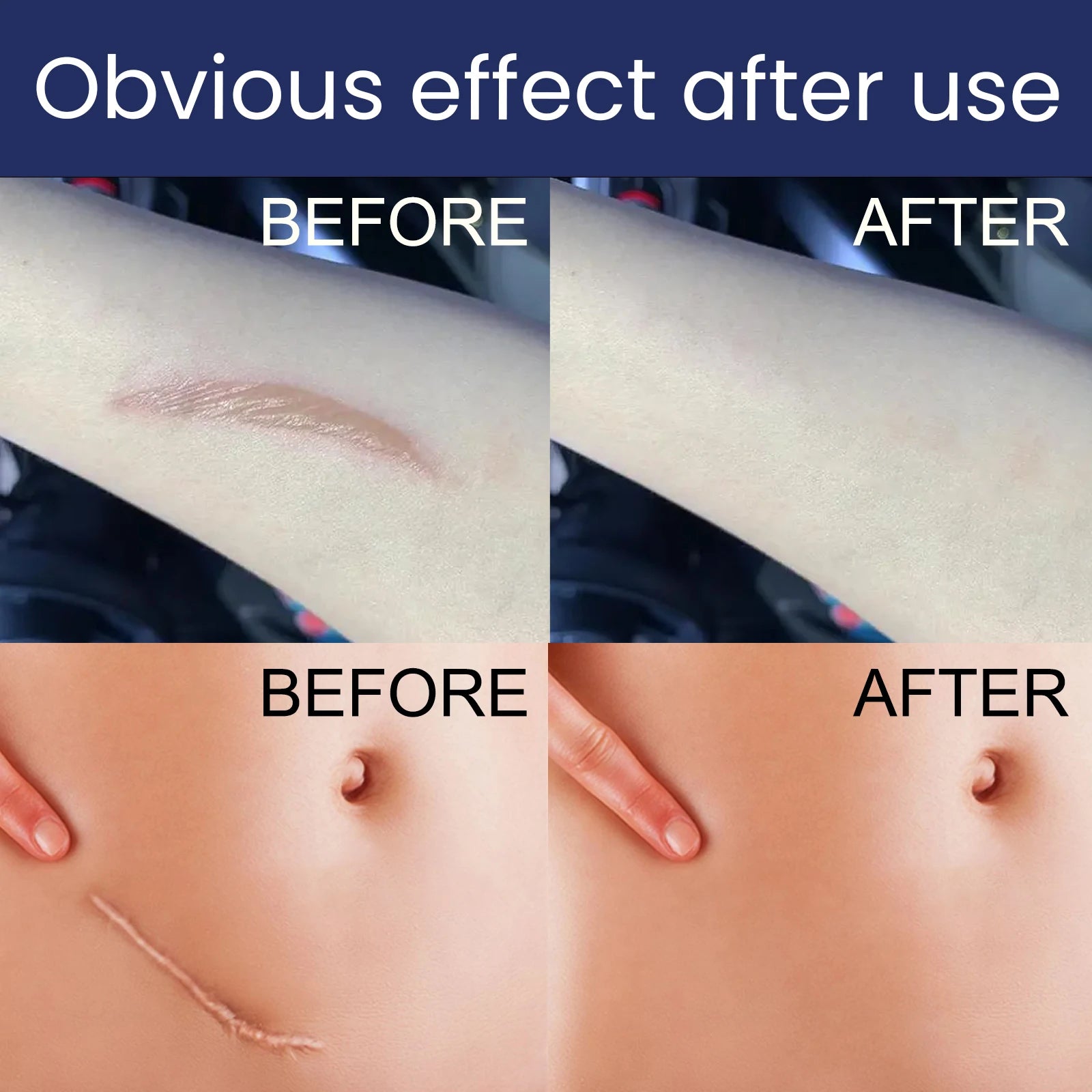 EELHOE Silicone Skin Scar Gel Retinol Niacinamide Scars Stretch Marks Burn Marks Deeply Nourish Skin Reduce Redness Swelling 30g