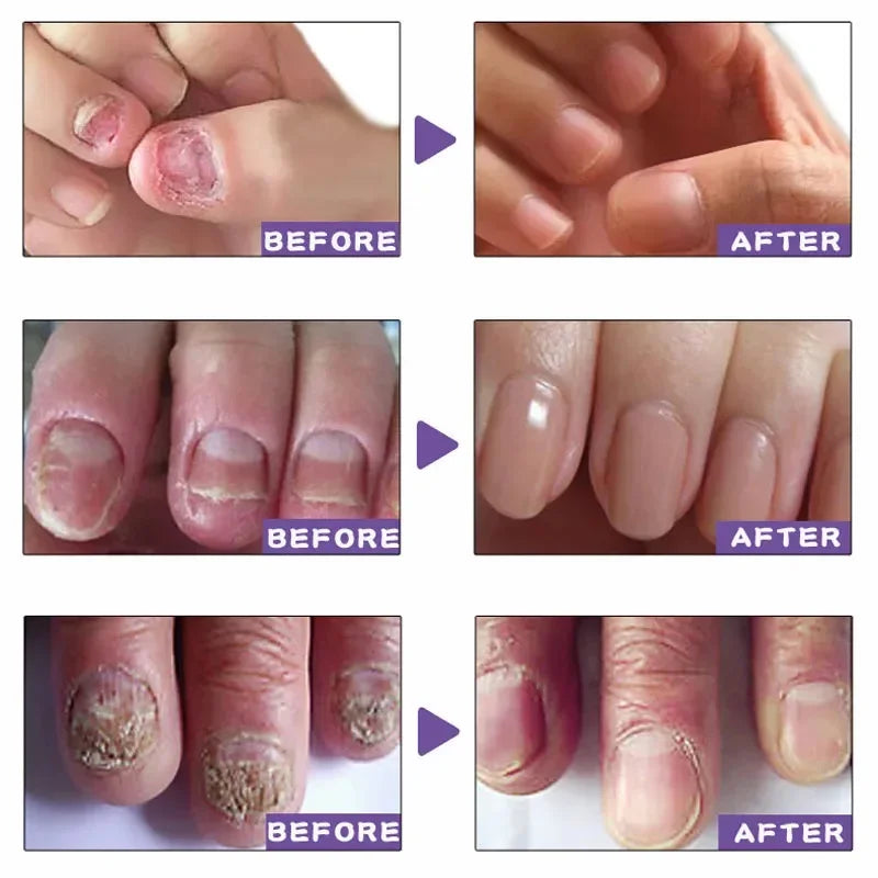 Nail Fungus Treatment Serum Foot Repair Liquid Toe Nails Fungal Removal Gel Anti Infection Paronychia Onychomycosis Cream 10ml