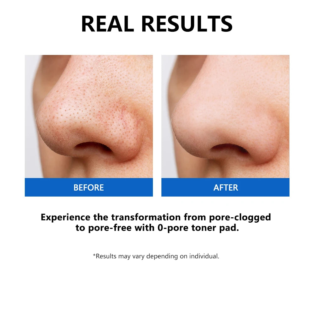 Zero Pore Toner Pads Control Oil Reduce Sebum Exfoliate Deep Clean Refines Pores Antioxidant Skincare Treatment  skincare korean