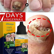 7 DAYS Nail Fungus Treatments Liquid Serum Anti-Infection Onychomycosis Paronychia Hand Care Nails Foot Fungal Removal Gel 10ml