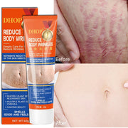 Stretch Marks Permanent Removal Cream Maternity Pregnant Women Pregnancy Anti-Winkle Smooth Repair Firming Skin Body Skin Care