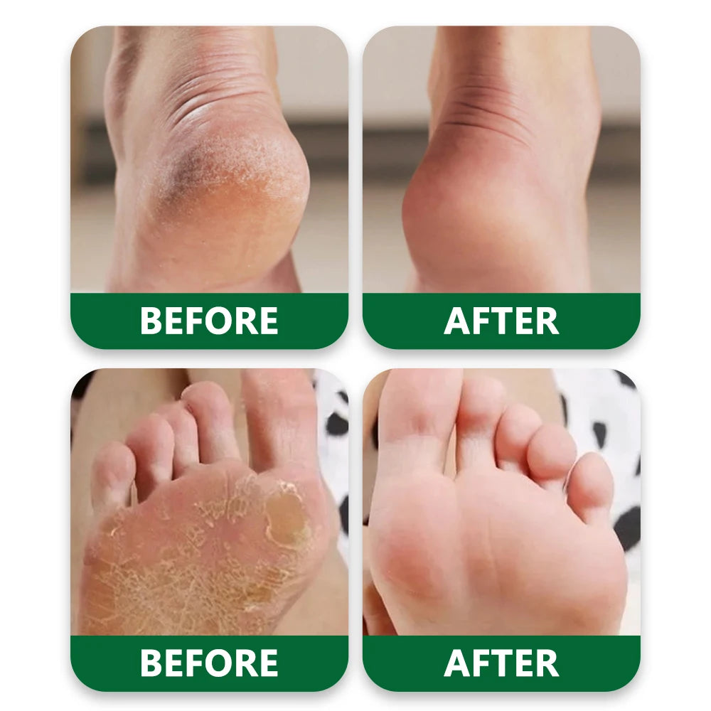 Tea Tree Oil Foot Cream, Warming Cream - Calluses, Dry Cracked Feet, Hands, Heels, Elbow -Softens & Moisturizes Skin, Foot Balm