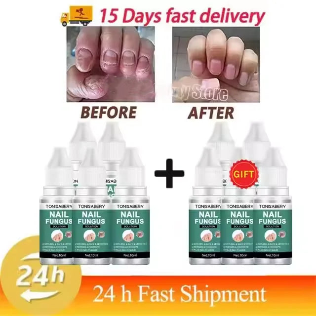 Nail Fungus Treatment Serum Foot Repair Liquid Toe Nails Fungal Removal Gel Anti Infection Paronychia Onychomycosis Cream 10ml