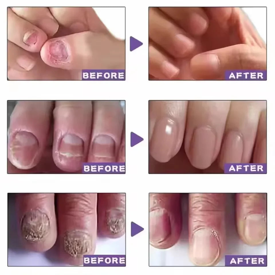 7 DAYS Nail Fungus Treatments Liquid Serum Anti-Infection Onychomycosis Paronychia Hand Care Nails Foot Fungal Removal Gel 10ml