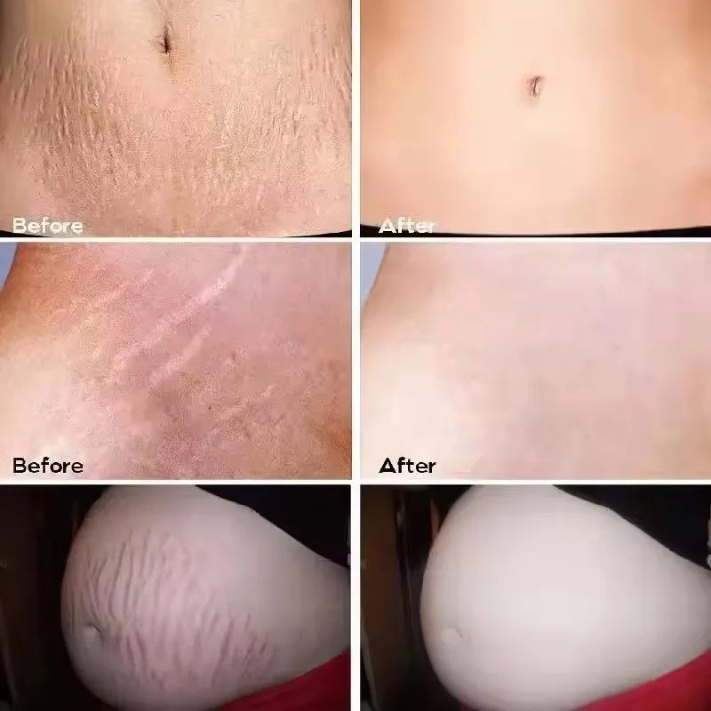 Stretch Marks Repair Cream Fade Lines Improve Duliness Tightness Long-lasting Moisturizing Smooth Enhance Elasticity Body Care